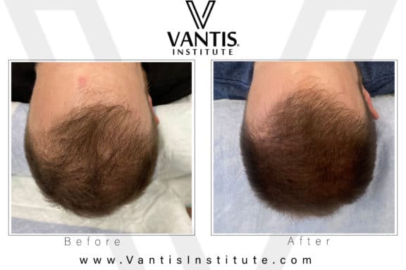 Hair Restoration Follicle Replication Vantis Institute